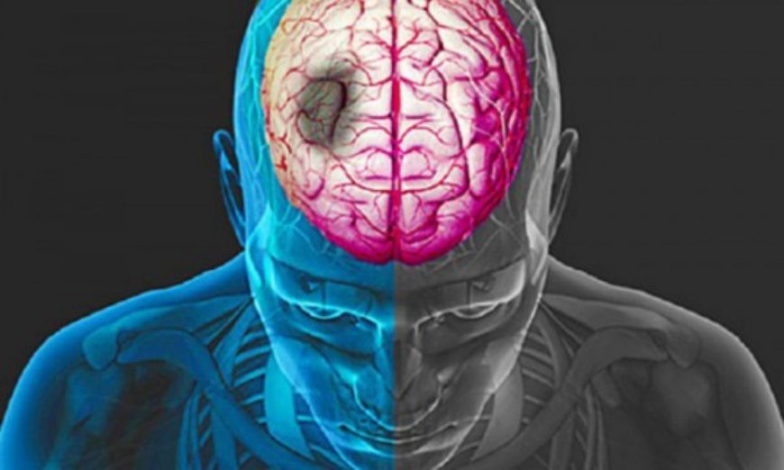 Entenda o que é o Acidente Vascular Cerebral, segunda maior causa de mortalidade no Brasil