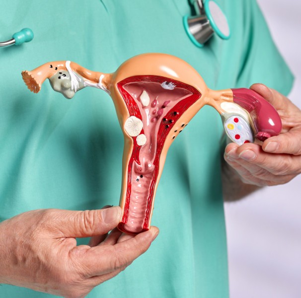 Endometriose: entenda o que é e qual o tratamento