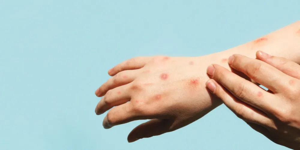 Casos de mpox se aproximam de 100 mil em todo o mundo, alerta OMS