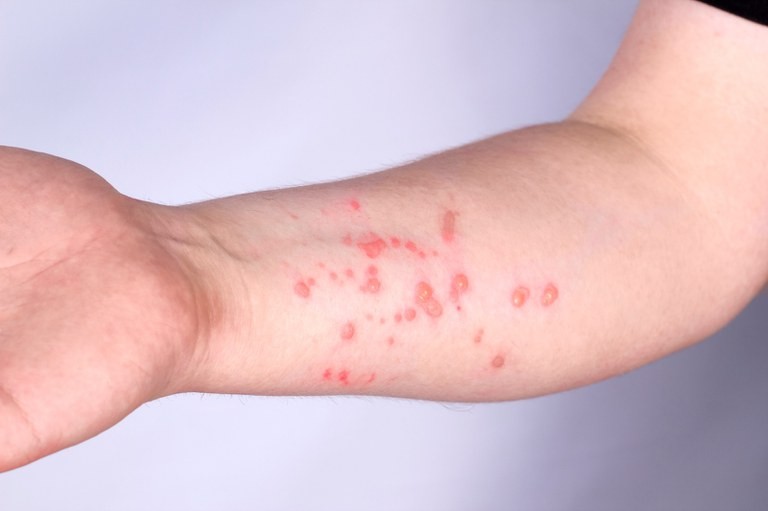 Homem de 27 anos testa positivo para Mpox em cidade de MS