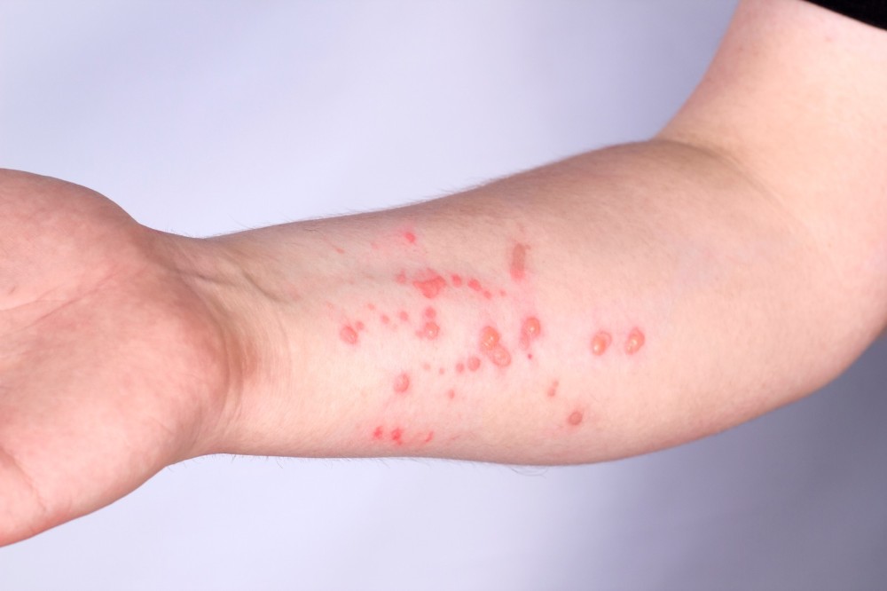 OMS convoca comitê para reavaliar emergência global por mpox