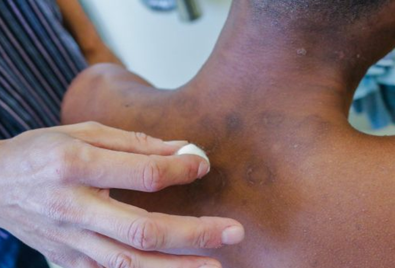 Brasil tem quase 30 mil novos casos de hanseníase por ano