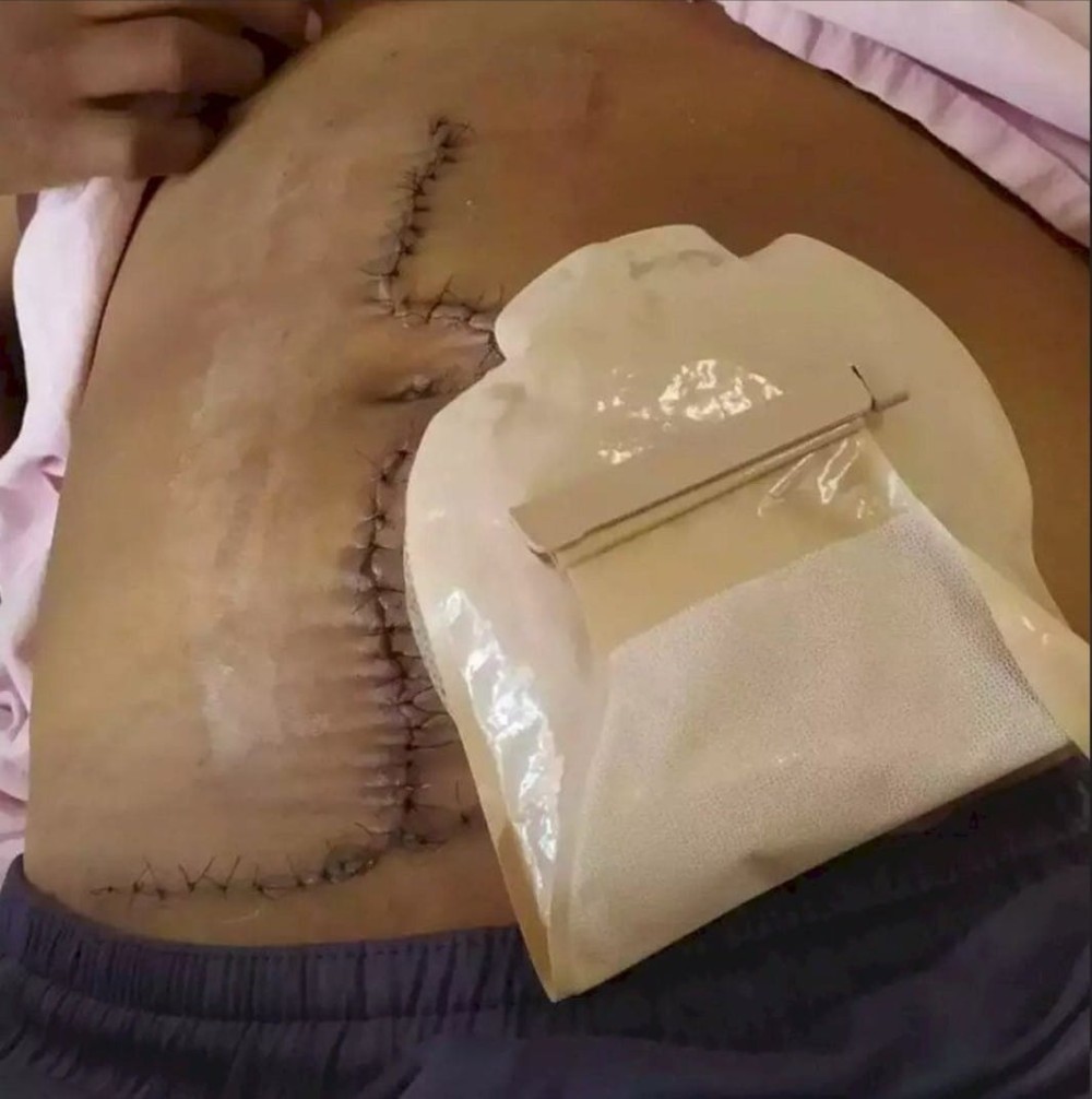 Médico deixa indígena quatro meses com gaze dentro do corpo