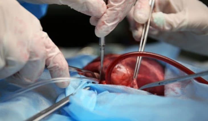 Fila do transplante de órgãos tem 428 pessoas em MS