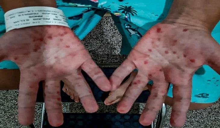 Saúde faz alerta após registrar surto da doença ‘mão-pé-boca’ em MS